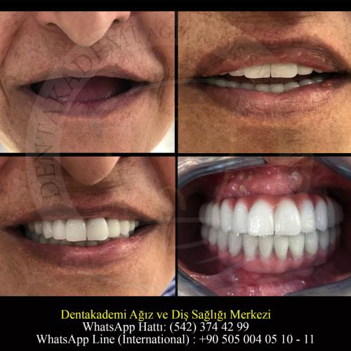 Dental bridge Before / After photo